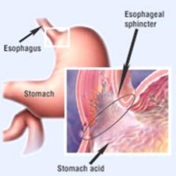 Savasság a gastroduodenite - nőtt, és ponizheennaya, tünetek, kezelés, diéta