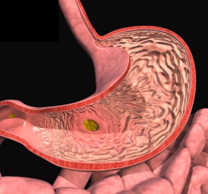 Savasság a gastroduodenite - nőtt, és ponizheennaya, tünetek, kezelés, diéta