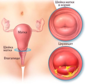 Krémes kiosztási (krém, mint egy krém) fehér, szagtalan, savanyú szagú ovuláció után (krém) Krémes kiosztási (krém, mint egy krém) fehér, szagtalan, savanyú szagú ovuláció után