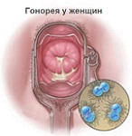 Krémes kiosztási (krém, mint egy krém) fehér, szagtalan, savanyú szagú ovuláció után (krém) Krémes kiosztási (krém, mint egy krém) fehér, szagtalan, savanyú szagú ovuláció után