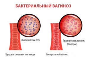 Krémes kiosztási (krém, mint egy krém) fehér, szagtalan, savanyú szagú ovuláció után (krémes) Krémes kiosztási (krém, mint egy krém) fehér, szagtalan, savanyú szagú ovuláció után