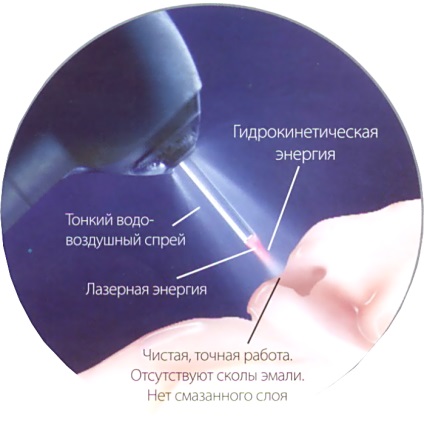 Lézeres fogászat Moszkvában, az árak lézeres fogászati ​​klinika