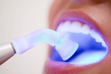 Gum lézeres kezelés előnyeit, javallatok és ellenjavallatok, vélemények és eljárások ár