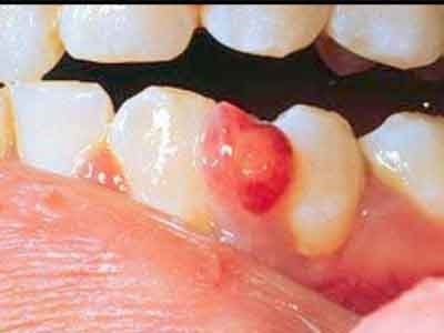 A kezelés fogászati ​​granuloma népi jogorvoslat