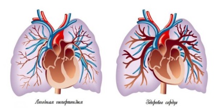 Tüdő- visszaáramlás okai, tünetei és kezelése