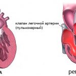 Tüdő- visszaáramlás okai, tünetei és kezelése
