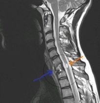 Mágneses rezonancia képalkotás a nyaki gerinc - előnyei és hátrányai