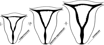 IUD behelyezés technikája - a fogamzásgátló menedzsment