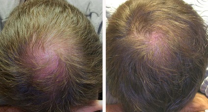 Mezoterápia haj - eljárást az egészséges fényét és sűrűség