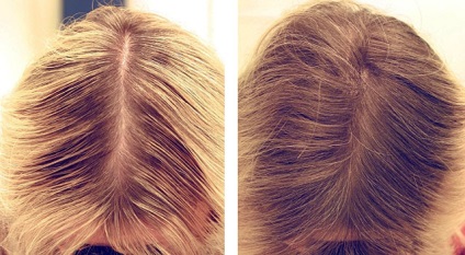 Mezoterápia haj - eljárást az egészséges fényét és sűrűség
