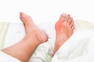 Osteoarthritis a láb etiológiájú tünetek, diagnózis és terápia