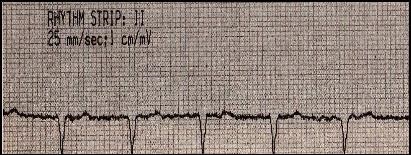 Paroxizmális tachycardia - studopediya