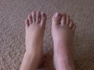 láb törés tünetei ízületi javítás boka törés után