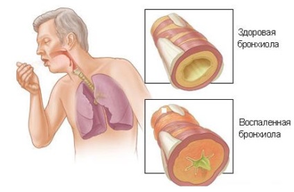 Tüdőgyulladás az idősek - pulmonológia - Medical Encyclopedia