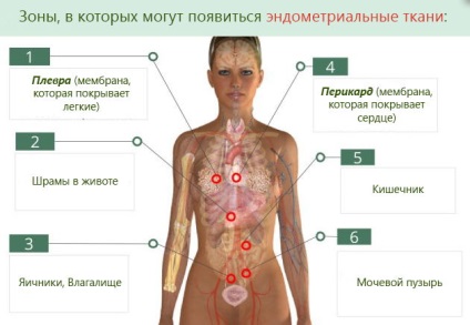 Az ok az endometriózis (ok) Az ok az endometriózis