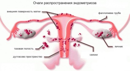 Az ok az endometriózis