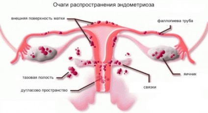 Az ok az endometriózis (ok) Az ok az endometriózis