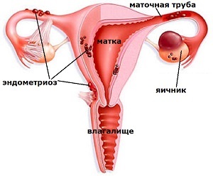 Az okok az endometriózis, méh és más szervek nők, hogy mi történik, és a tünetek