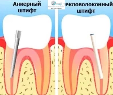 Protézisek a csapok a fogászatban Moszkvában, az előnyök a fogazat pótlások