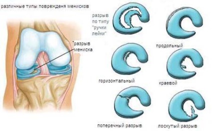 Törés a hátsó szarv a mediális meniscus tünetek és kezelés