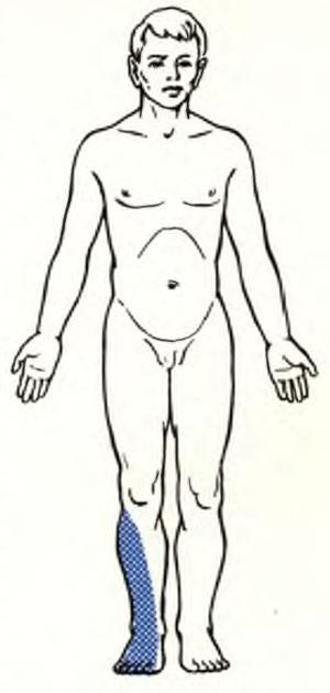 Radikuloishemii artériás szindróma (bénító isiász gyökérzetet szindróma típus) - szindrómák
