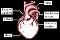 Sinus Valsalva (aneurizma) sinus Valsalva