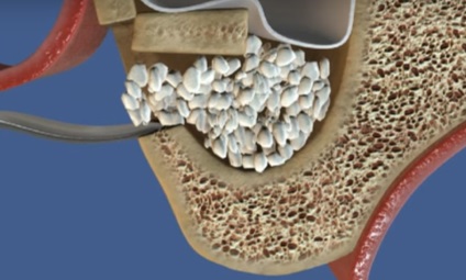 Az élettartam garancia az implantátumok, az oka az idő előtti csere (csere) Implantátum Élettartam garancia oka az idő előtti csere