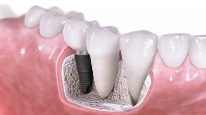 Az élettartam garancia az implantátumok, az oka az idő előtti csere (élettartam) Implantátum Élettartam garancia oka az idő előtti csere