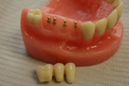 Az élettartam a fogászati ​​implantátumok részletei szabályai ellátás implantátum
