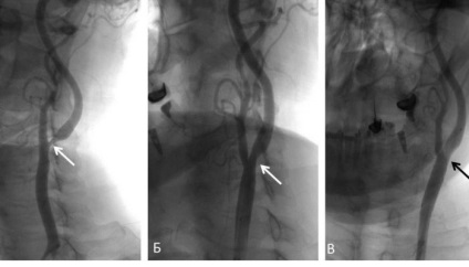 Szűkület a artéria vertebrális tünetek (a tünetek) Gerinc-artériába stenosis tünetek