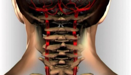 Szűkület a artéria vertebrális tünetek (a tünetek) Gerinc-artériába stenosis tünetek