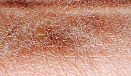 Száraz bőr okozza, gondoskodás, tisztító száraz bőr, a szervezet tisztító az emberi egészség