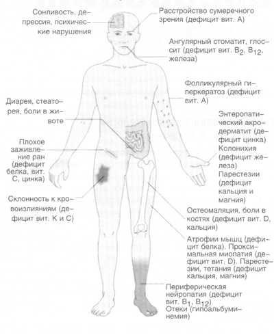 Terápiás Klinika felszívódási zavar szindróma diagnózis és kezelés - Orvosi Encyclopedia