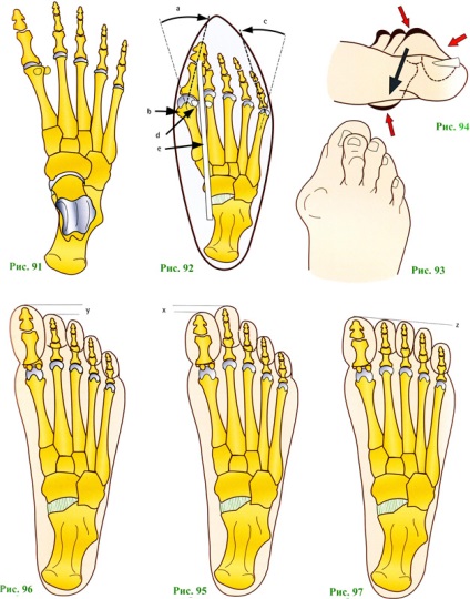 Típusai stop - fiziológia, az ízületek, a lábfej boltozat talp - műtéti és kezelési