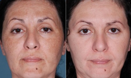 Ultrahangos arcbőr peeling - megtisztítja a bőrt ultrahang, ultrahangos készülék peeling,