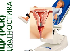 Ureaplasma in Women - tünetek és kezelés