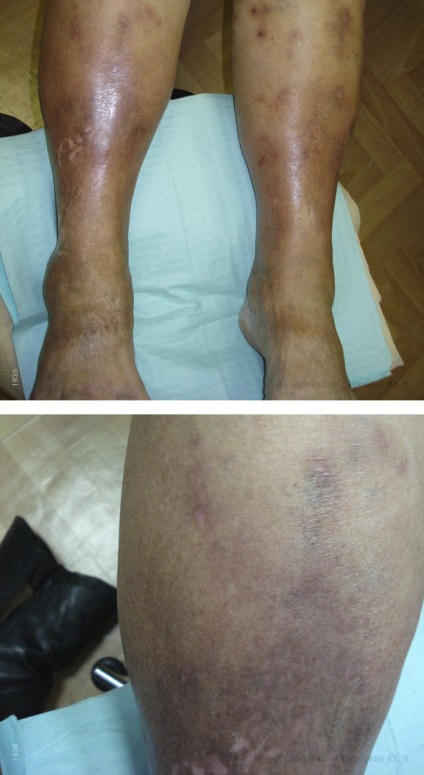 Visszértágulás dermatitis okai, tünetei, és a betegség stádiuma, a kezelés