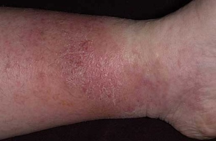 Visszeres dermatitis tüneteit, fotó, kezelés