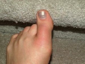 Zavar a hüvelykujj okozza és a kezelés a láb