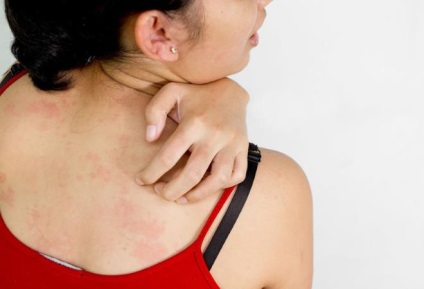 Viszkető allergiás dermatitis okai és diagnosztika