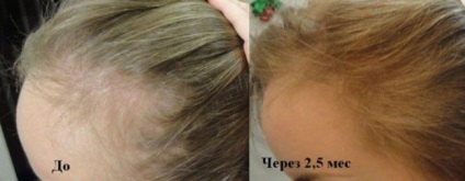 Alerana - Sampon hajhullás ellen véleménye, smink, haj növekedési hatás