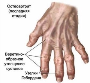 Osteoarthritis a kezek okok, kezelés, gyakorlatok, fotók