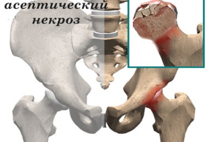 A térdízület kezelésének spontán osteonecrosisa
