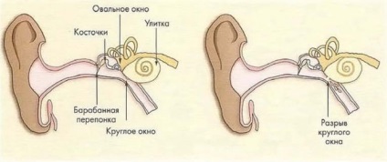Barotraumát a fül és a dobhártya kezelés, patogenezisében, a tünetek