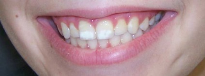 Fehér foltok a fogakon felnőtteknél - okok és kezelés, gyönyörű