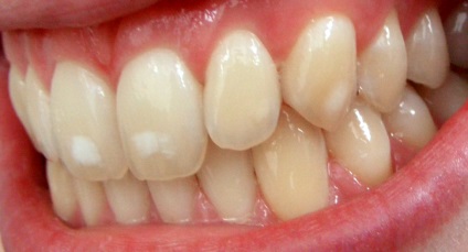Fehér foltok a fogakon felnőtteknél - okok és kezelés, gyönyörű