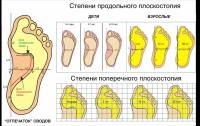 Fájdalom a láb alatt a lábujjak - okai, kezelése és megelőzése