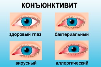 Mi a teendő, ha az orrfolyás és könnyező szem - hogyan kell kezelni