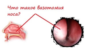 Mi vasotomy orr (is) Mi vasotomy orr