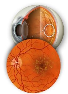 szemészeti retina degeneráció